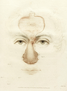 wat-is-ayurveda-joseph-constantine-carpue